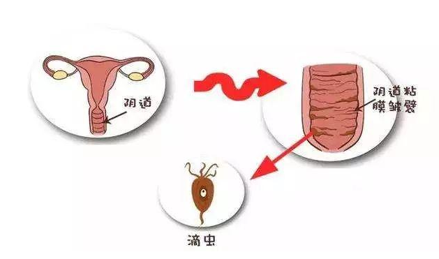 附件炎症状,附件炎用药,附件炎治疗,附件炎原因